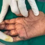 Kite-injuries