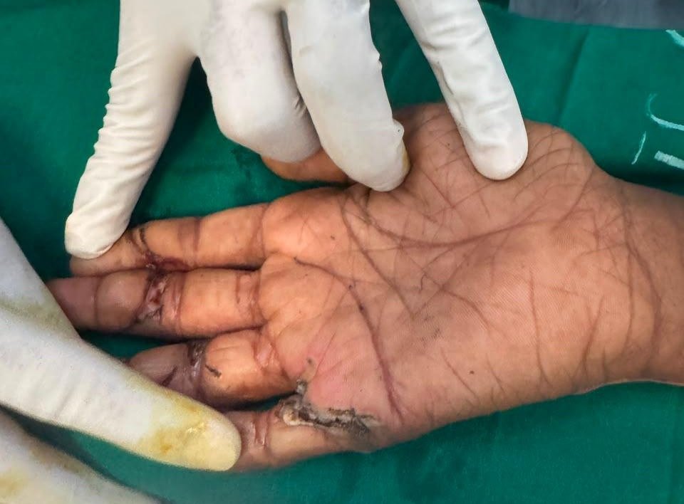 Kite-injuries